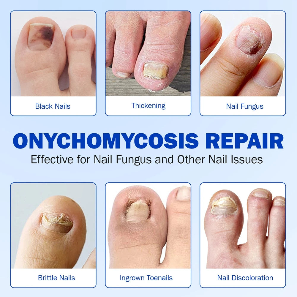 Nail Fungus Patch Waterproof Nail Repair Patch Ingrown Correction Sticker Damaged Nail Gray Care Patch Feet Care Tools