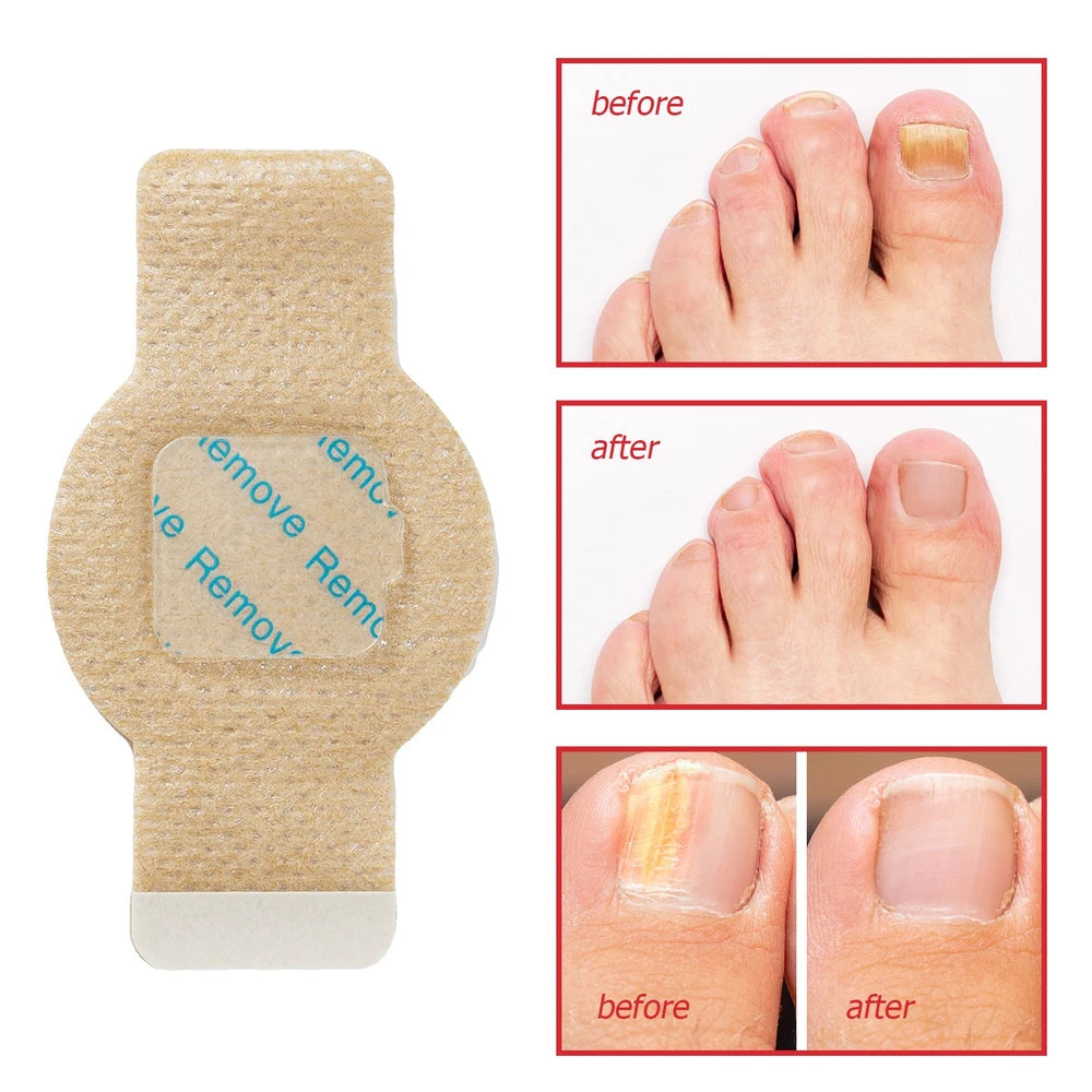 Nail Fungus Patch Waterproof Nail Repair Patch Ingrown Correction Sticker Damaged Nail Gray Care Patch Feet Care Tools